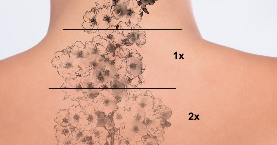 Tattooentfernung mit Laser Hautarzt Dr. Freudenberger